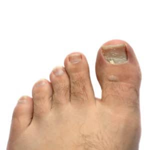 Person with toenail fungus on big toe