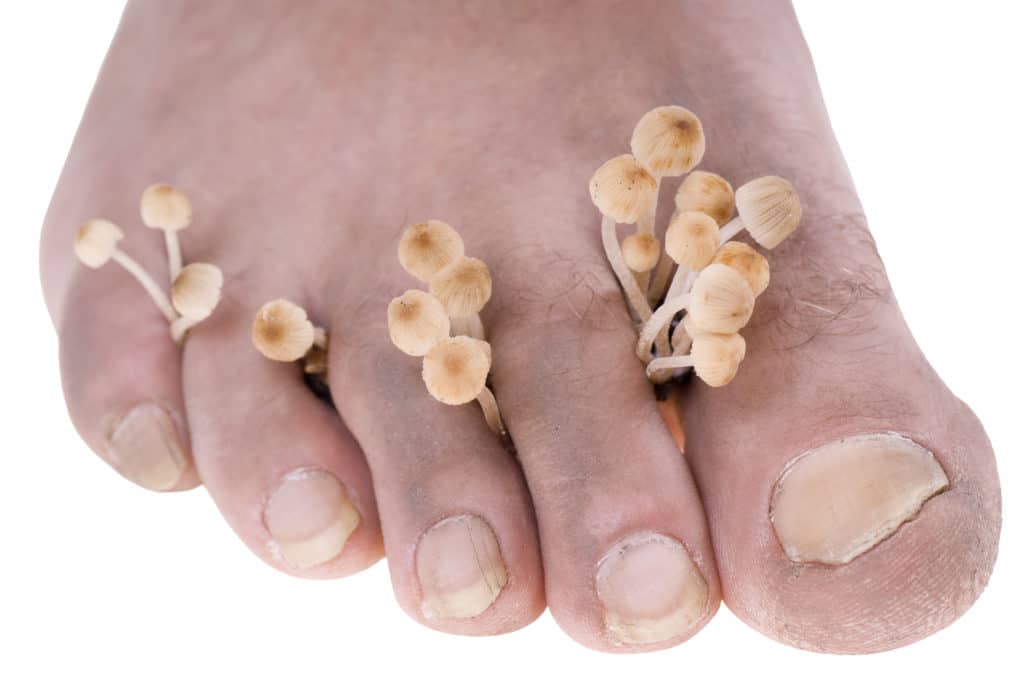 why-are-my-toenails-turning-yellow-mcvay-foot-ankle-colorado-springs