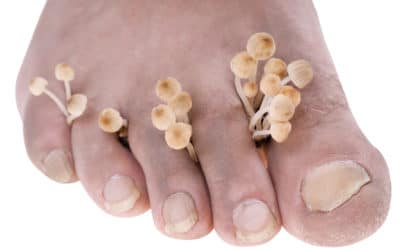 Why Do Toenails Turn Yellow? Causes, Treatment, and Prevention in Colorado Springs