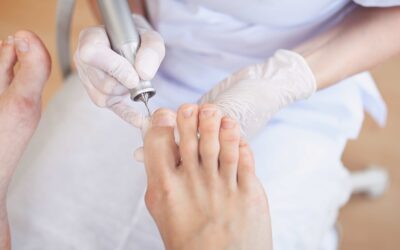 Ingrown Toenail Surgery