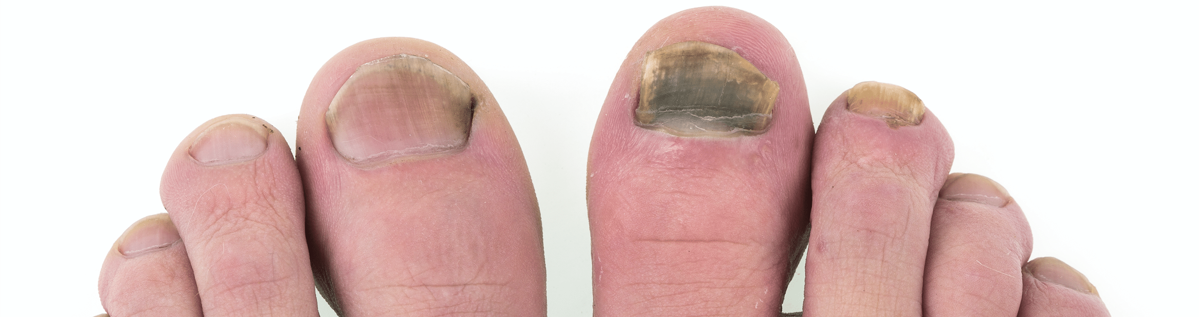 Close-up of fungal and ingrown toenails
