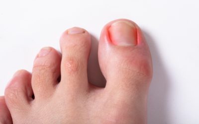 Are Your Shoes Causing You Ingrown Toenail Pain?