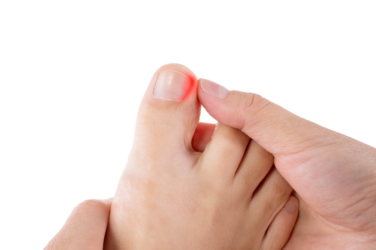 ingrown toenail inflicted area